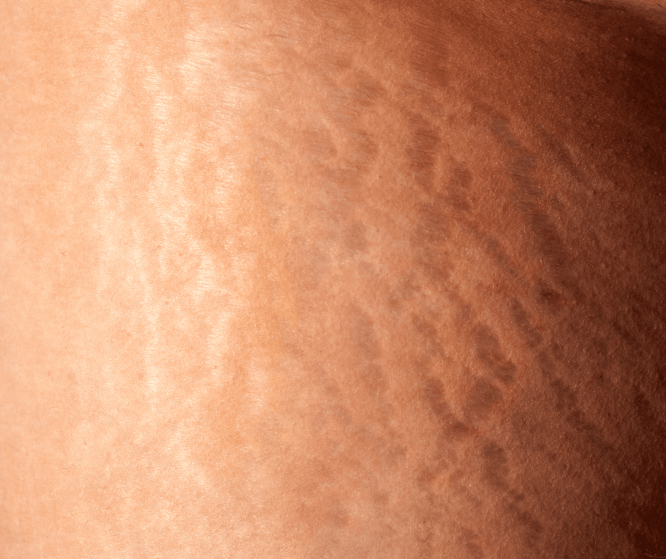 Stretch Marks & Cellulite Treatment
